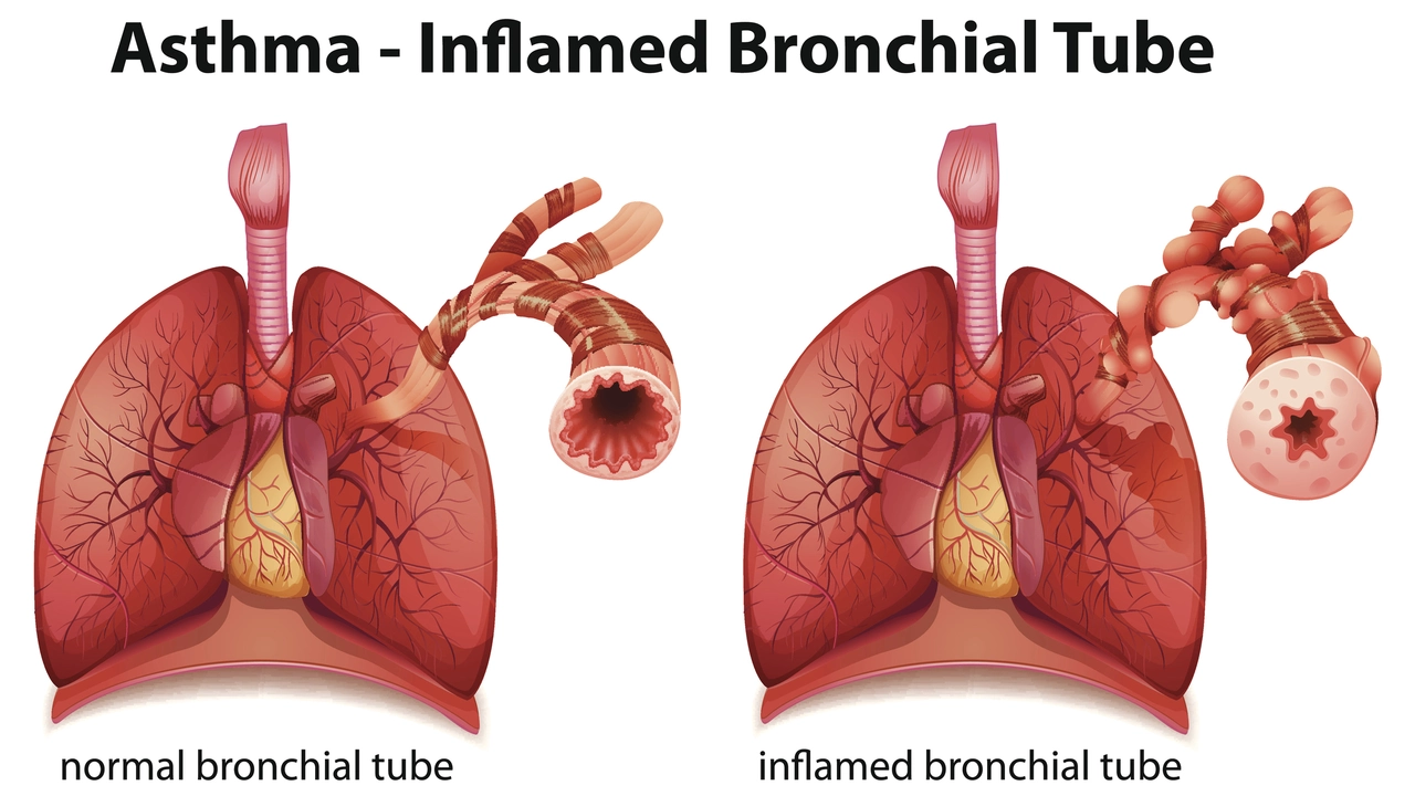 Die Verbindung zwischen zystischer Fibrose und Asthma